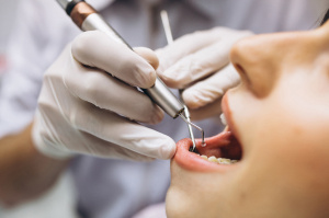 Киста и гранулема зуба. Методы лечения зубов с хроническими заболеваниями